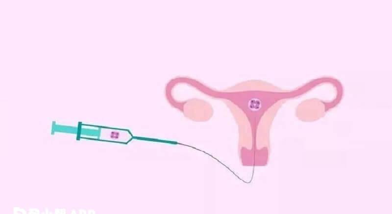 试管婴儿宫腔灌注的流程