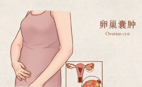 卵巢囊肿易导致女性不孕