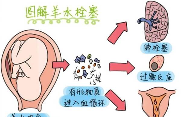 胎膜早破是羊水栓塞的常见原因