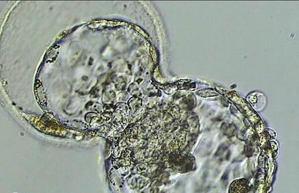 囊胚移植数量不能决定试管婴儿成功率