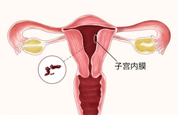 子宫内膜薄要针对原因改善调理