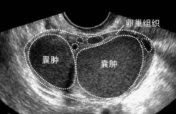 卵巢囊肿手术后多补充营养