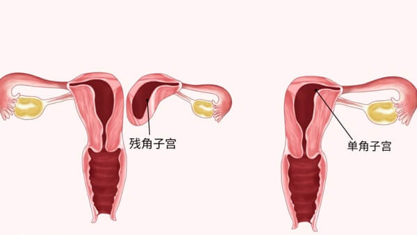 子宫畸形属于先天生殖道畸形