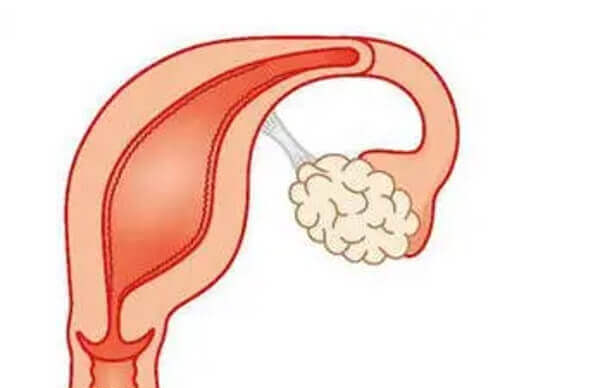 单角子宫药物治疗后可改善子宫内环境