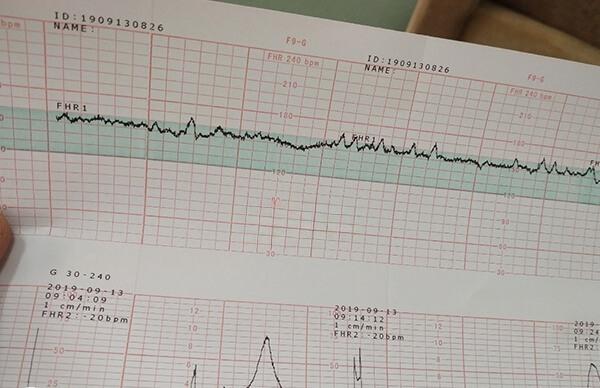 胎心基线是否达标对胎儿健康很重要
