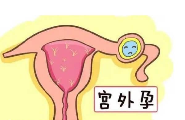 试管婴儿也会患上宫外孕