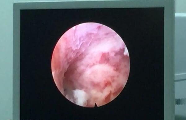 宫腔镜检查能清晰观察到子宫状态