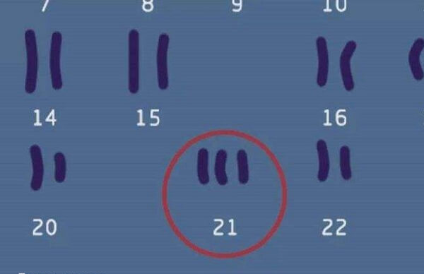 预防21号染色体三体遗传能避免唐氏儿