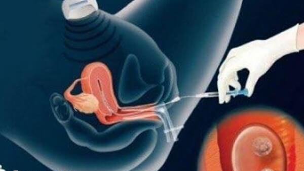 取卵手术后女性卵巢需要一段时间恢复