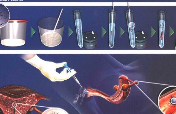 太原做人工授精的条件