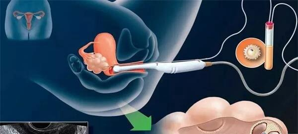 取卵是太原三代试管的流程之一
