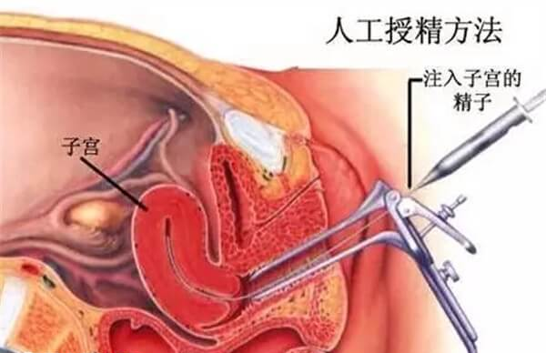 西藏人工授精成功率约15%-20%