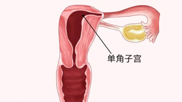 子宫畸形大多对生育不利