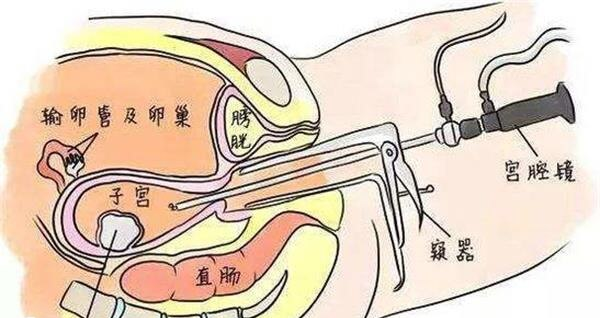 试管前宫腔镜不仅能检查还能治疗