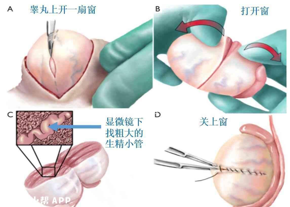 非梗阻性无精子症可显微取精