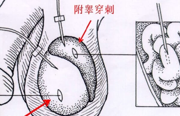 显微取精找到精子的几率高