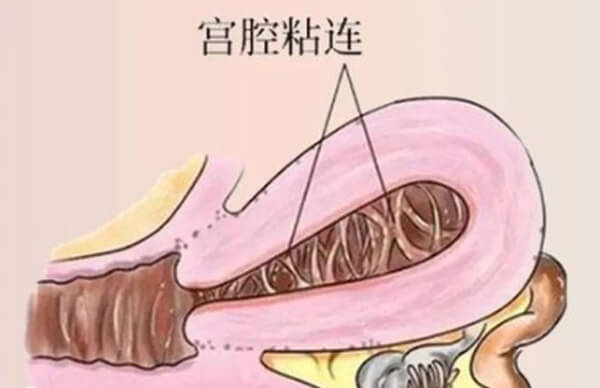 轻度宫腔粘连必须先治疗再移植