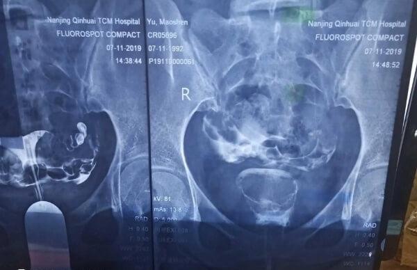 严重盆腔粘在试管婴儿前要先接受治疗
