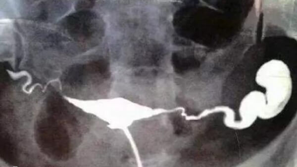 输卵管积水不利于试管婴儿胚胎着床