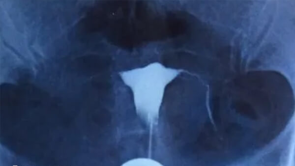 输卵管积水不利于试管婴儿成功