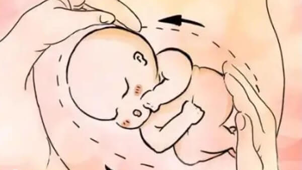试管婴儿多胎妊娠的风险高