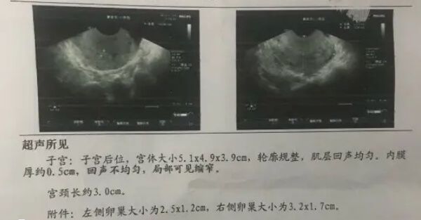 内膜变薄不利于着床