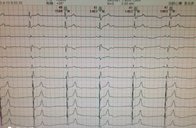 试管移植成功后要做心电图