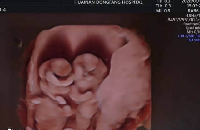 试管婴儿双胞胎的妈妈们要注意营养