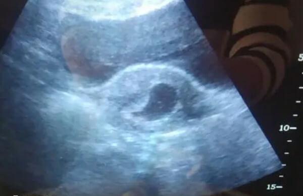 孕囊偏小要注意营养摄入