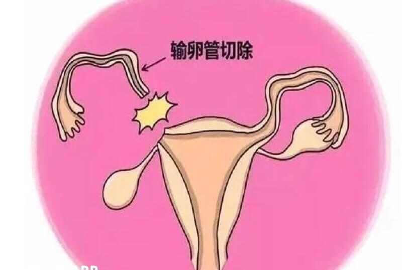 输卵管切除手术对于身体有一定损伤