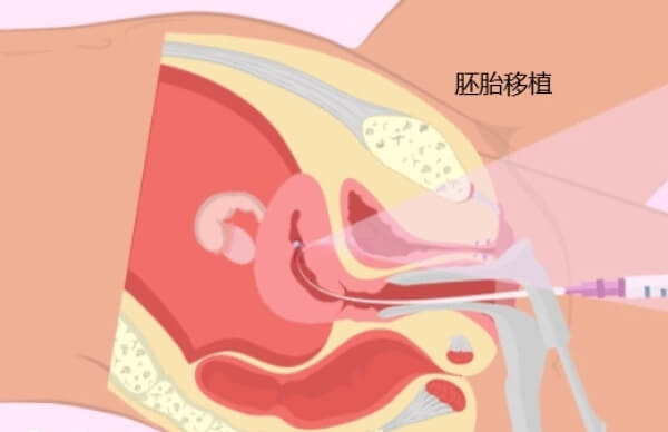 胚胎移植后不能需要适当休息