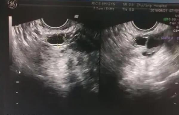 排卵可能会有排卵痛