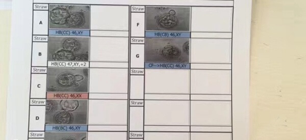 超长方案适合子宫内膜异位症的