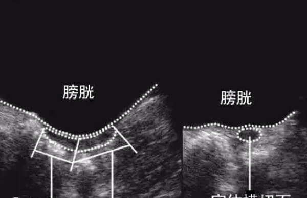 幼稚子宫还有怀孕的可能