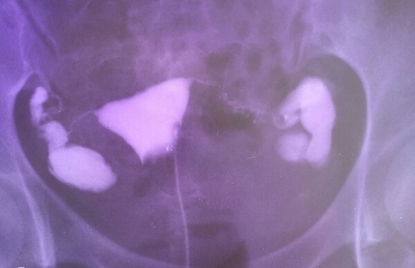输卵管积水会影响做试管婴儿