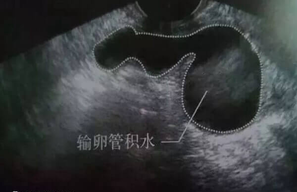 输卵管严重积水需要在试管婴儿前先结扎