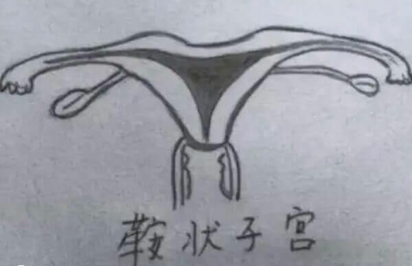 弓形子宫即鞍状子宫