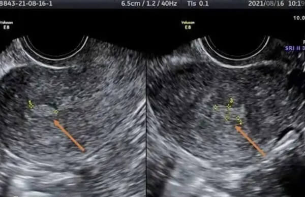 子宫内膜回声不均匀可能存在息肉