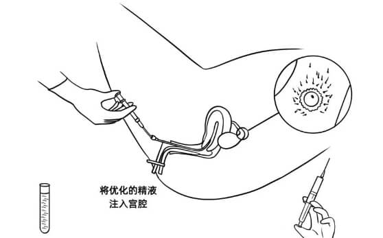 人工授精手术图