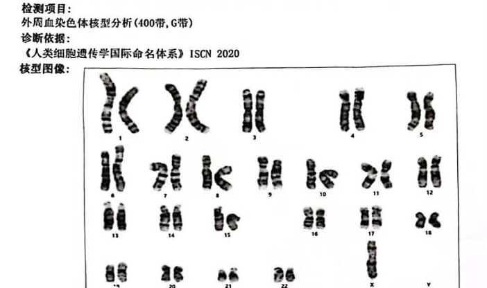 特纳综合征染色体核型