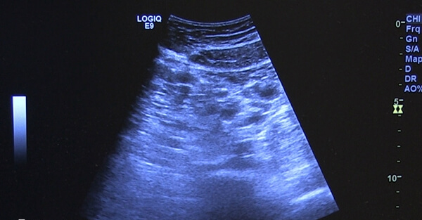 窦卵泡数可以评估卵巢功能