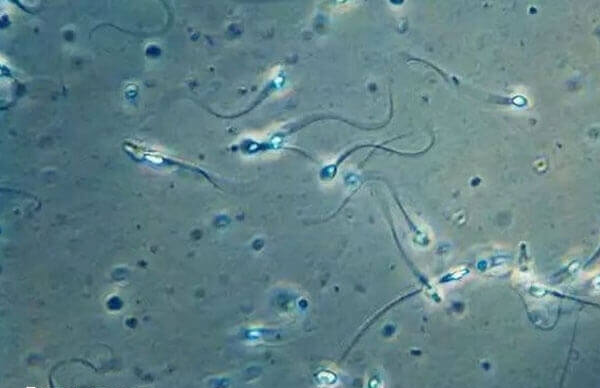 炎症可导致精液不液化