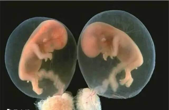 试管婴儿可以移植两个胚胎