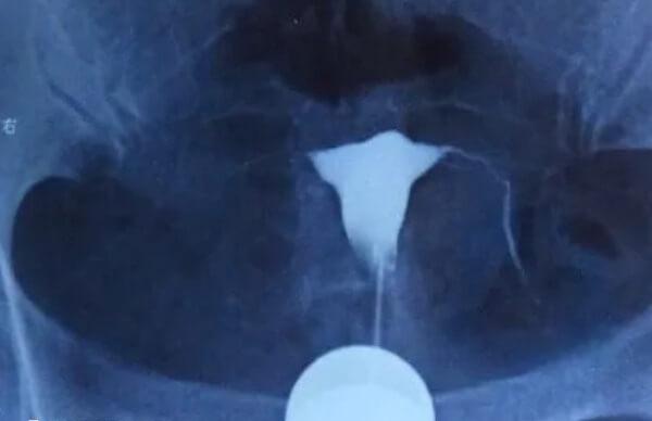 没有输卵管不能自然受孕