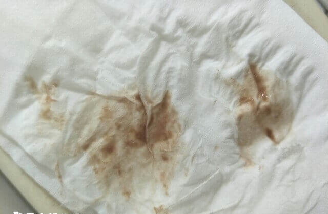 试管移植着床失败是流咖啡色血原因之一