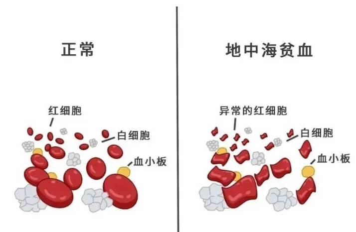 地中海贫血症