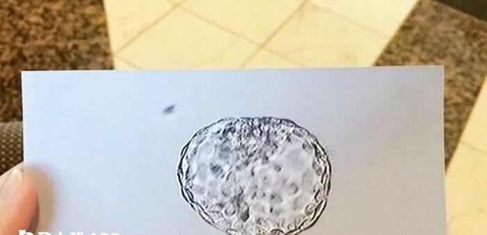 做试管婴儿移植1枚胚胎也能得到好结局