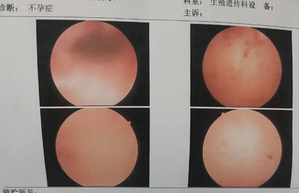 宫腔粘连需要手术治疗