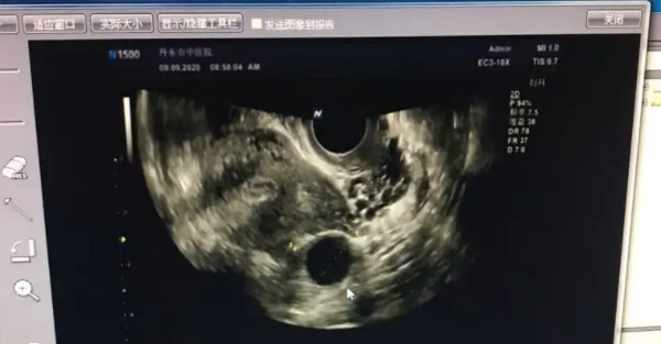 基础卵泡少要尽快备孕