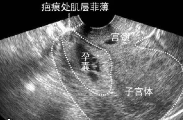 瘢痕子宫不影响取卵
